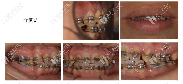 在维乐口腔做牙齿矫正一年之后的牙齿情况