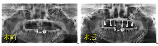 案例|半口6颗植体做即刻种植牙只要2小时,且当天戴冠吃东西