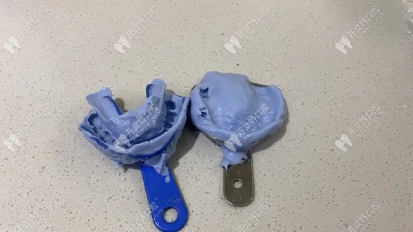 制作的牙模图示 制作的牙模图示
