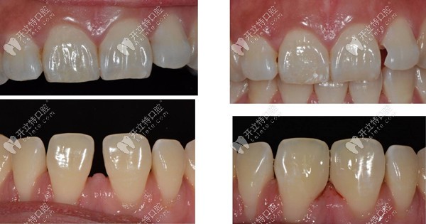 集结了嵌体材料种类的分类,必知用它修复牙齿的优点