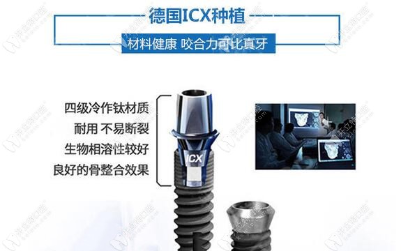 德国icx种植牙的材料介绍与特征 德国icx种植牙的材料介绍与特征