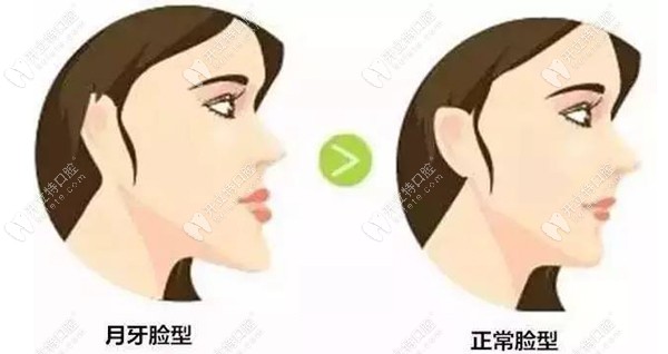 矫正失败还是成功对比明显