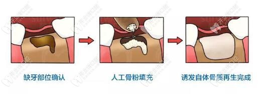 种植牙填骨粉