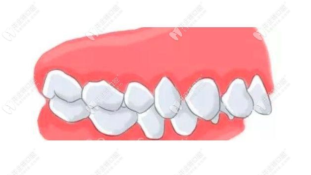 凸嘴症状-上颌突出