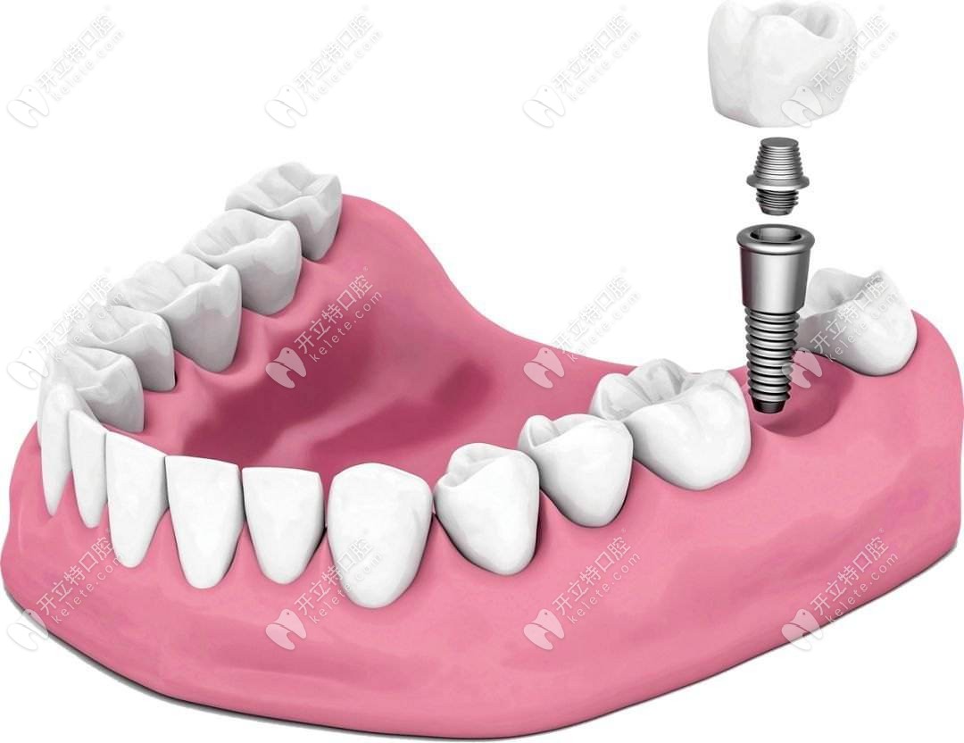 做种植牙的不仅伤口小还愈合快