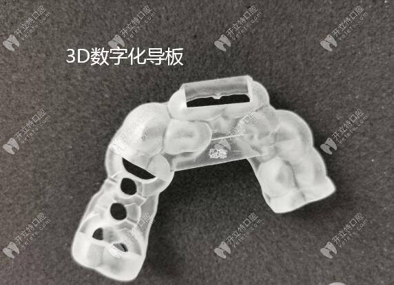 3D数字化导板种植牙技术