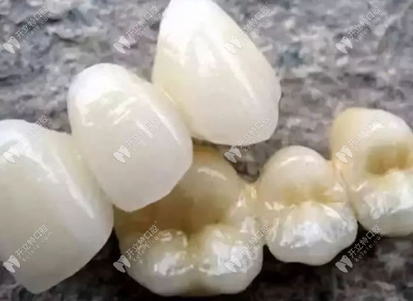 进口全瓷牙冠系列