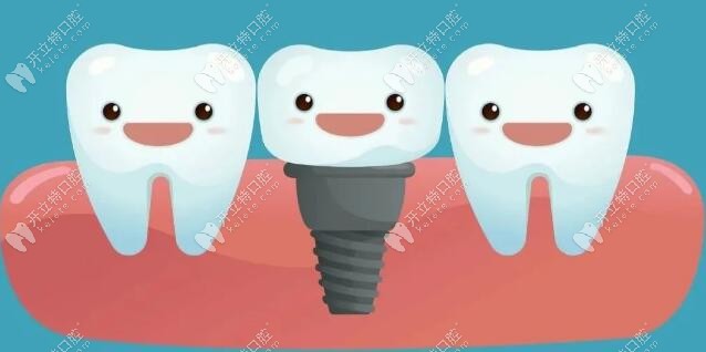 种植牙是缺失牙较好的修复方式