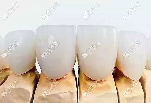 前门牙做氧化锆全瓷牙的效果图