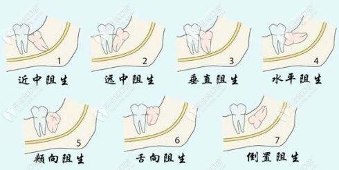 智齿难度不同价格也不同哦 智齿难度不同价格也不同哦
