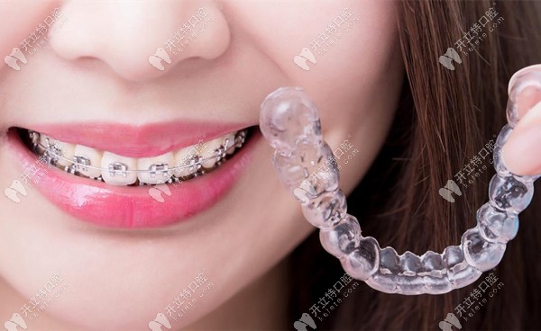 朔州市朔城区天天口腔的隐形牙齿矫正价格在18800元起