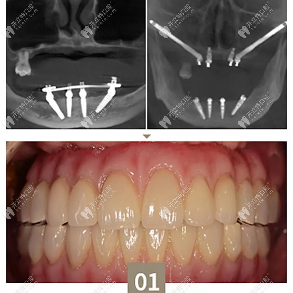 牙槽骨及颌骨条件非常差的情况