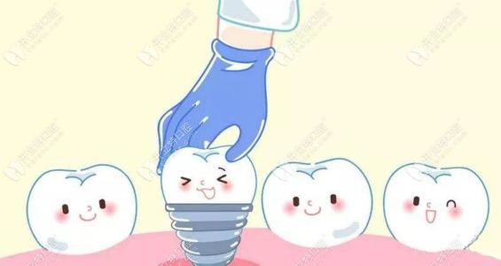 种植牙价格表 种植牙价格表