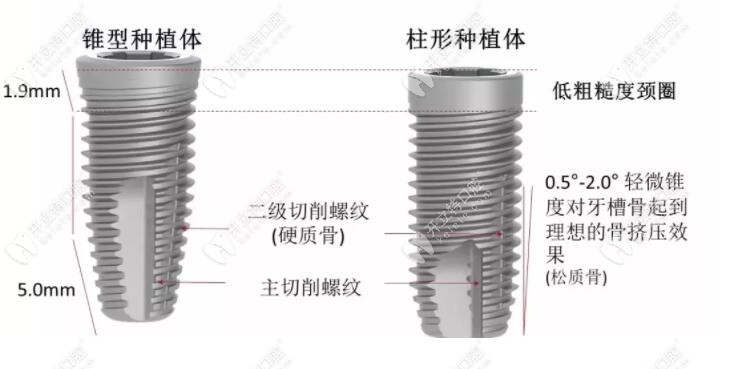 瑞典高端neoss亲水种植体大概多少钱一颗?材质对人体好不好