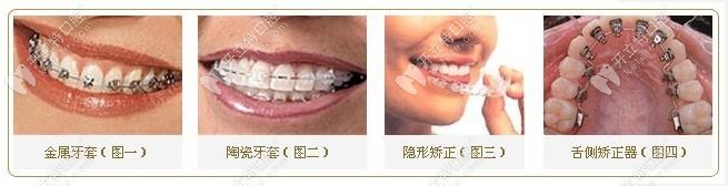 不同的矫正器对比 不同的矫正器对比