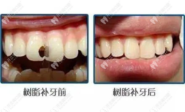 树脂补牙前后效果对比