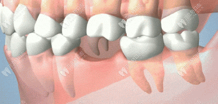 缺牙的危害有哪些