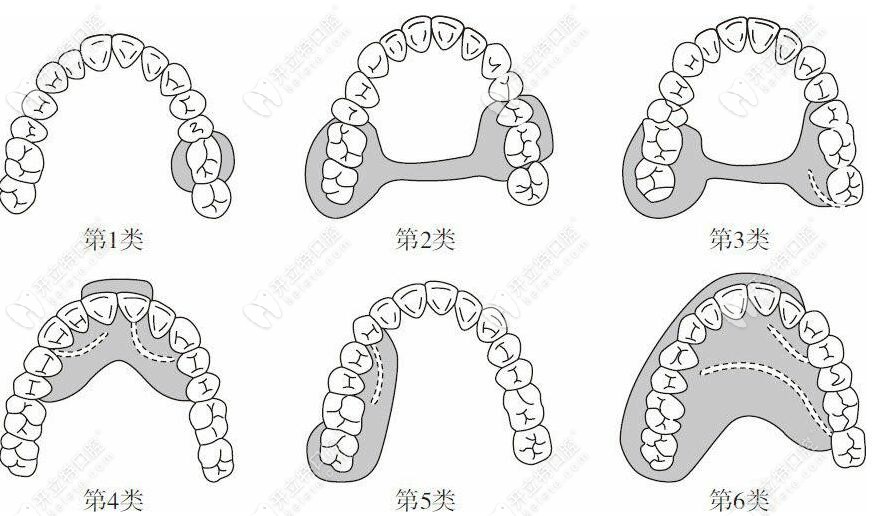 可摘局部义齿卡环的种类那么多,就想知道其中RPI卡环的特点