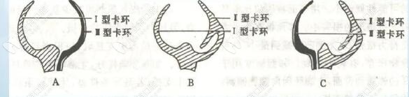 混合型卡环 混合型卡环
