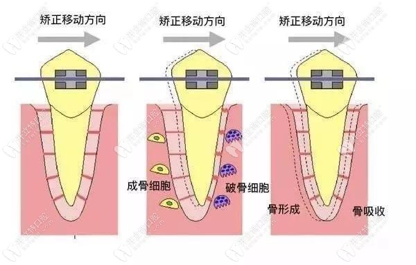 牙齿矫正时的移动方向