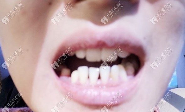 磨牙后的牙齿