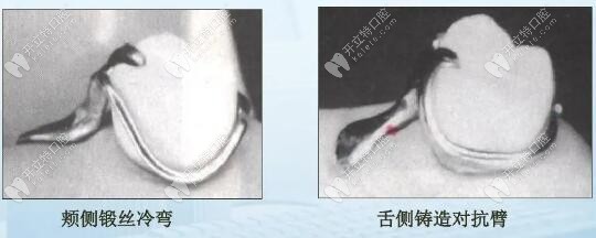 结合型卡环 结合型卡环
