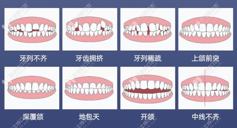 牙齿正畸适应症状