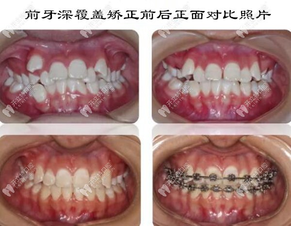 前牙深覆盖矫正前后正面对比照片