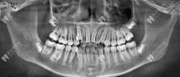 深覆合牙齿矫正前CT片