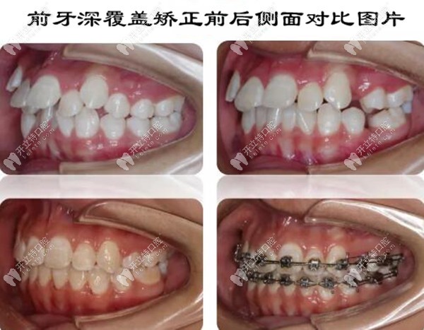 前牙深覆盖矫正前后侧面对比图片