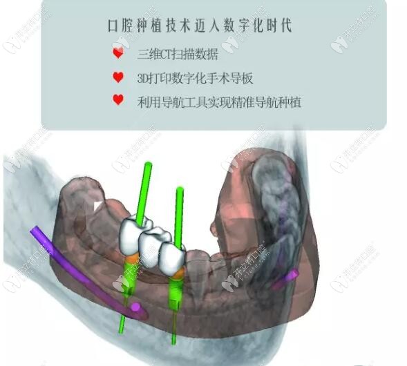 3d导板种植牙