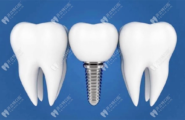 对金属过敏的人并非都不能做种植牙,因为种植体是纯钛材质