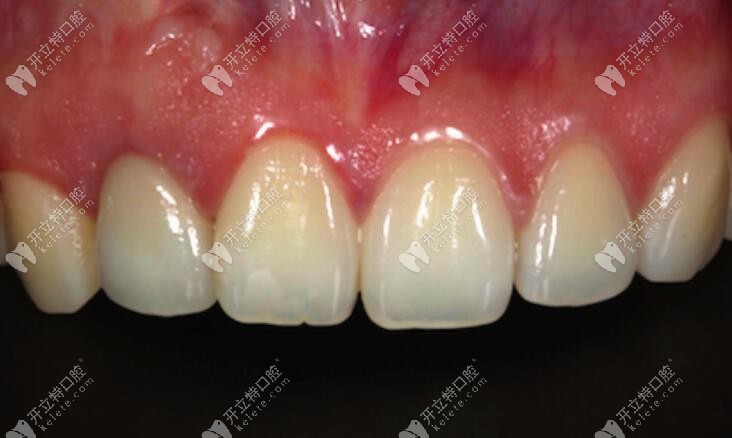 种植门牙美学修复之牙冠穿龈轮廓的精确复制