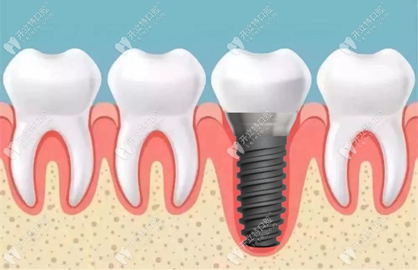 种植牙在槽骨中的动漫展示图