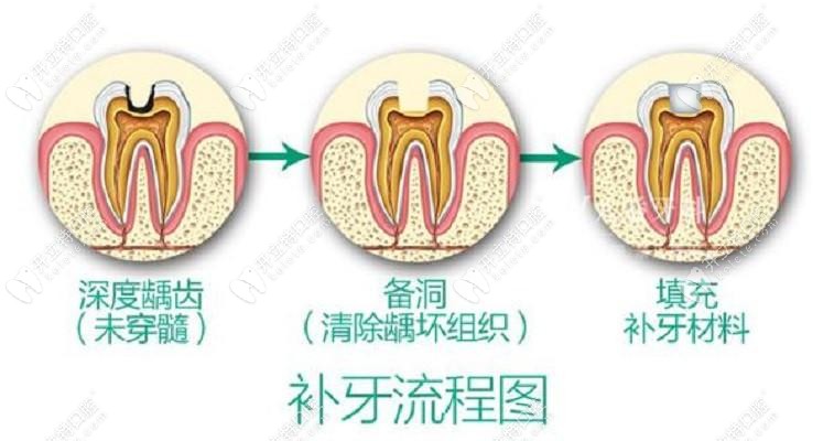 補牙流程圖