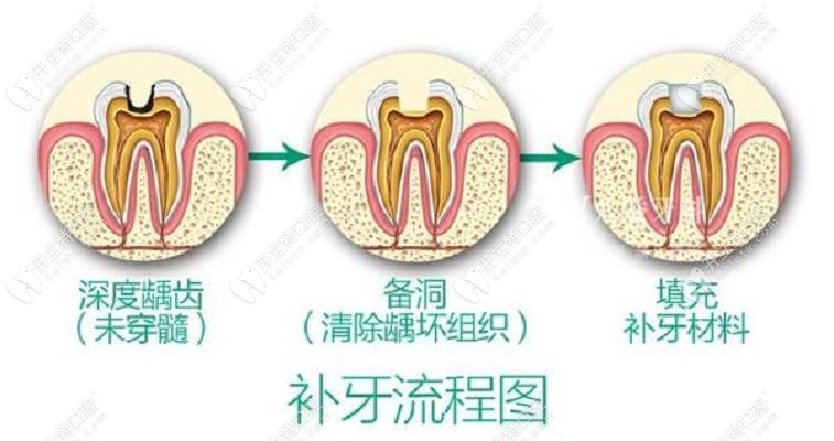 补牙流程图