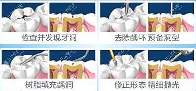 扬州贝恩口腔树脂补牙过程