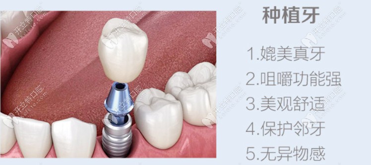种植牙的优势