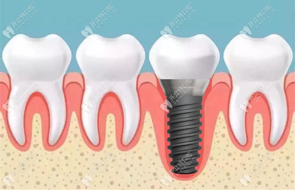医生技术会影响种植牙的使用效果