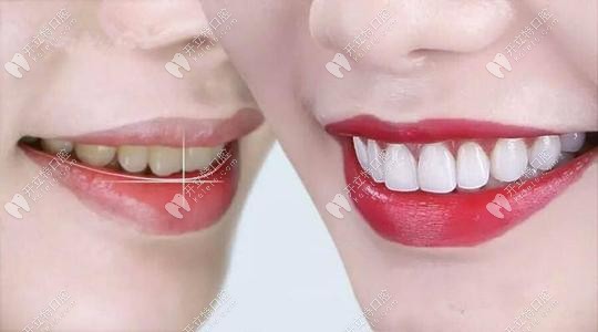 皓齿美白前后对比 皓齿美白前后对比