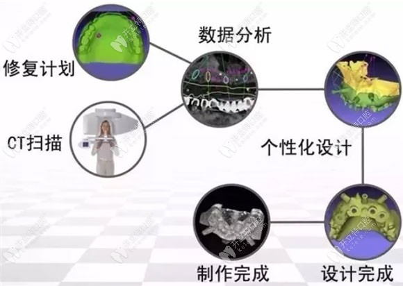 3D导板数字化种植牙展示图