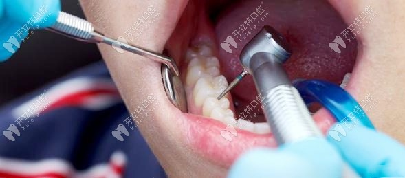 牙科基础治疗图