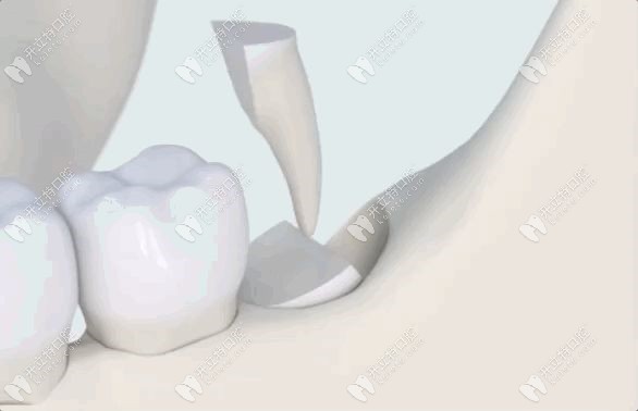 微创拔牙是爱芽口腔的特色技术