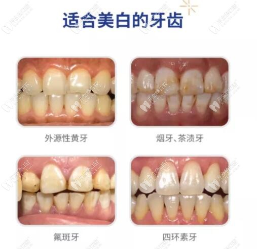 牙齿美白适应症 牙齿美白适应症