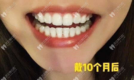 牙齿错乱在福华口腔戴牙套10个月的效果