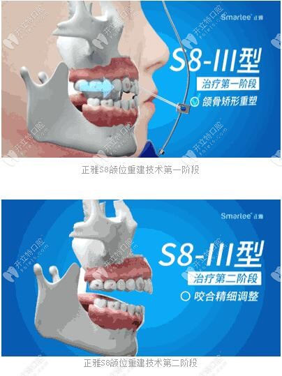 正雅S8、S9、S10颌位重建术 正雅S8、S9、S10颌位重建术