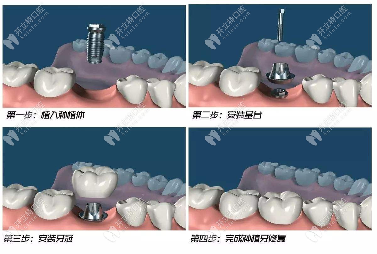 种植牙操作流程