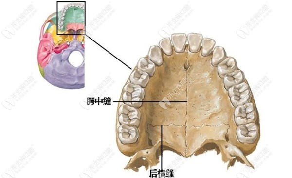 mse骨性扩弓是什么