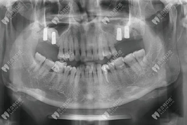 牙槽骨量不足用上颌窦外提升做种植牙修复