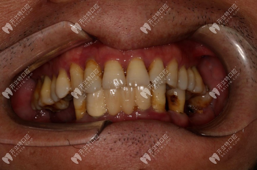 牙齿缺失的口腔正面照